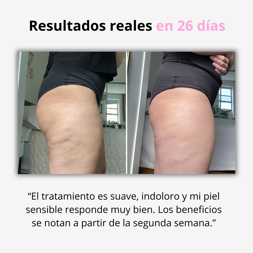 DermaSlim™ Masajeador Anticelulítico de 3 Pasos