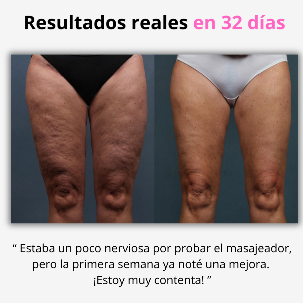 DermaSlim™ Masajeador Anticelulítico de 3 Pasos
